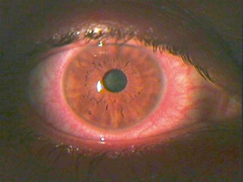 Acute Red Eye Non‐ulcerative Keratitis Associated With Mini‐scleral