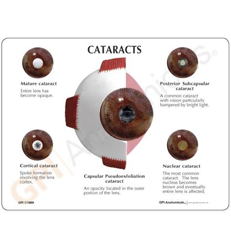 Anatomical Model Cataract Eye