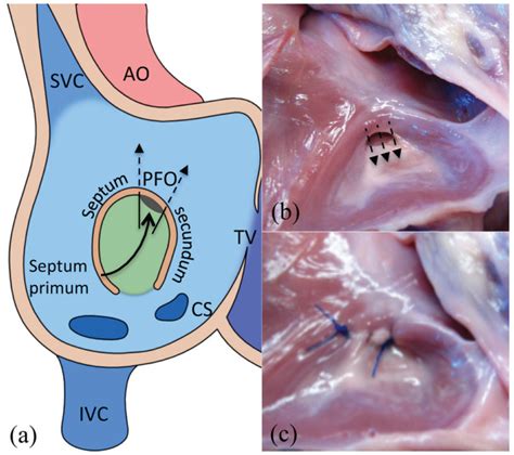 Patent Foramen Ovale Pfo And Surgical Closure A Right Atrium View