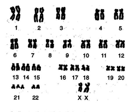 Down syndrome is caused by an abnormal cell division the karyotype is 46xx or 46xy with a translocation between a supernumerary chromosome 21 and. Down Syndrome karyotype (trisomy 21): chromosomal condition caused by the presence of all or ...
