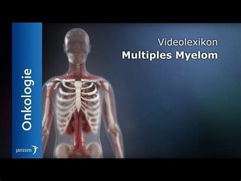 Diagnose Des Multiplen Myeloms Aktualisierte Kriterien Medizin