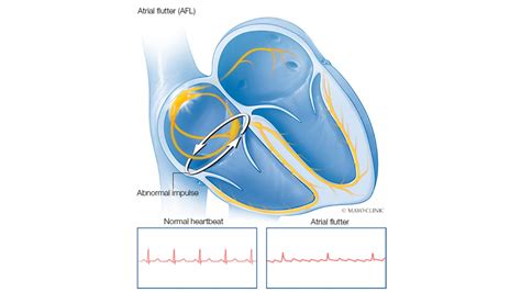 Heart Rhythm Webinar Series Challenging Case Discussion With Mayo Clinic Experts On Atrial