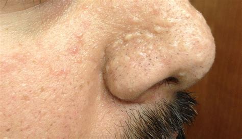 Sebaceous Gland Hyperplasia On Lips