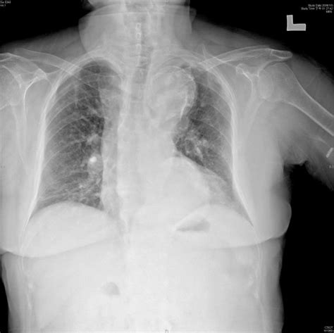 Aortic Dissection Core Em