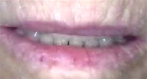 Actinic Cheilitis Pictures Treatment Causes Symptoms