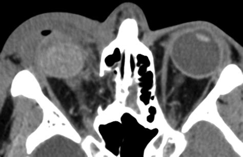 Imaging Of Orbital Trauma Radiographics