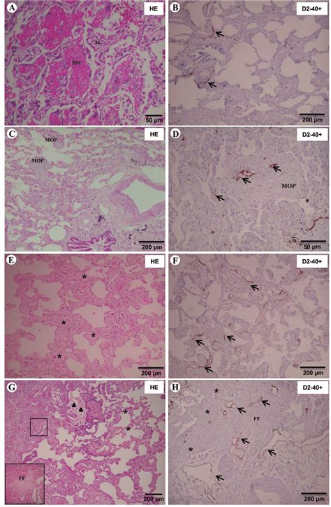 Histology Of The Diffuse Alveolar Damage A B Organizing Pneumonia