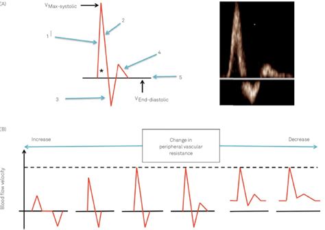 Arterial Doppler Waveforms A Normal Doppler Morphology In A Lower