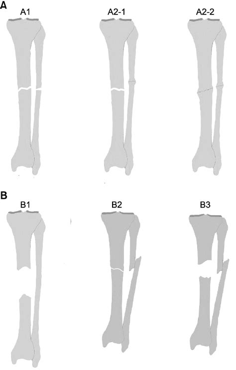 Classification Of Nonunions By Paley Et Al A Type A Nonunion B