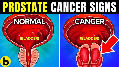 10 Warning Signs You May Have Prostate Cancer Youtube