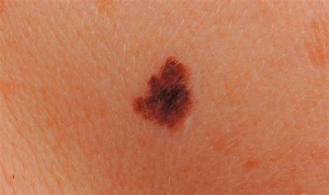 Skin Cancer Symptoms How Moles Look When Youve Got The Deadly Disease