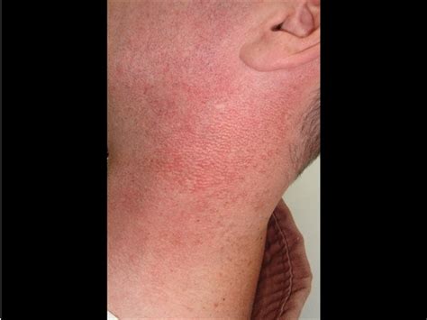 Derm Dx A Growing Rash On A Man With A History Of Sun Exposure