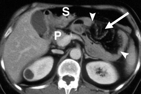 Ct Of Internal Hernias Radiographics