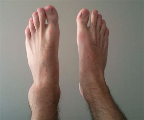 Soccer Ankle Sprains Occur More Often When The Two Feet
