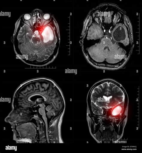 Magnetic Resonance Imaging Of A Patient With A Temporal Horn Cyst Of