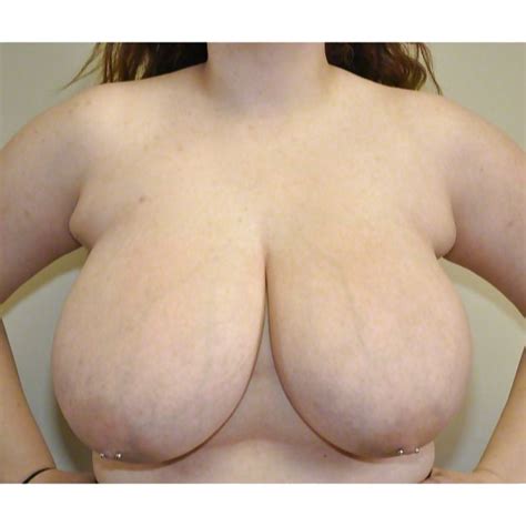 Pre Breast Reduction Tits 2 94 Pics Xhamster