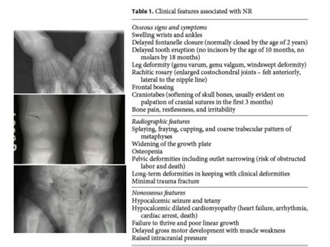 Nutritional Rickets