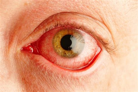 Covid Symptoms Sore Itchy Eyes Could Be Early Coronavirus Warning