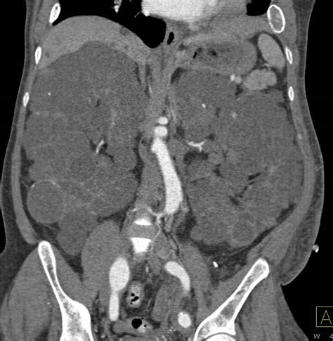 Polycystic Kidney Disease With Polycystic Liver Disease Kidney Case