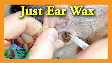 Smaller or oddly shaped ear canals may make. Ear Wax Removal Doctor | Auburn Medical Group | Doovi