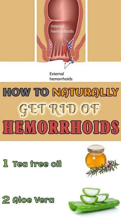 How To Naturally Get Rid Of Hemorrhoids 10 Home Remedies Discover How
