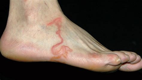 Squirming Worm Infection In Foot Au