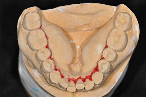 Dental Impressions For Patients With Lingual Tori Lee Ann Brady Dmd