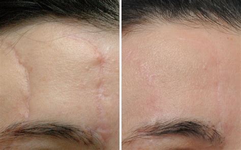 Before And After Nw Laser