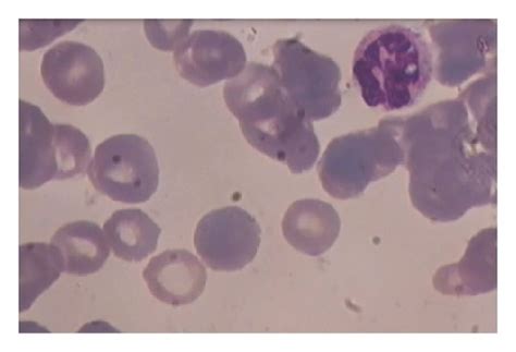 A Peripheral Blood Smear A Hypersegmented Neutrophil Is Found On The