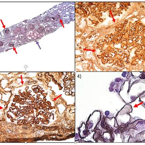 Renal Biopsy Membranous Glomerulonephritis And Highlighting Of Igg And
