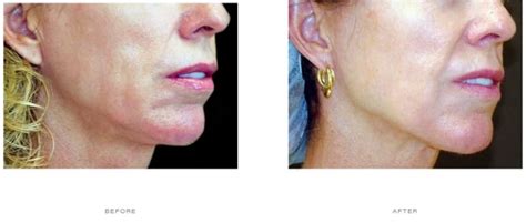 Thermage Before and After | The Cosmetic Skin Clinic