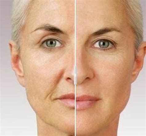 Advanced Bioidentical Hormone Therapy Botox Fillers Before And After
