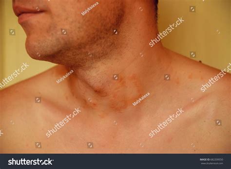 Allergic Skin Rash Spots On Neck Foto Stok 682209550 Shutterstock