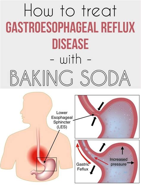 How To Treat Gastroesophageal Reflux Disease With Baking Soda Reflux