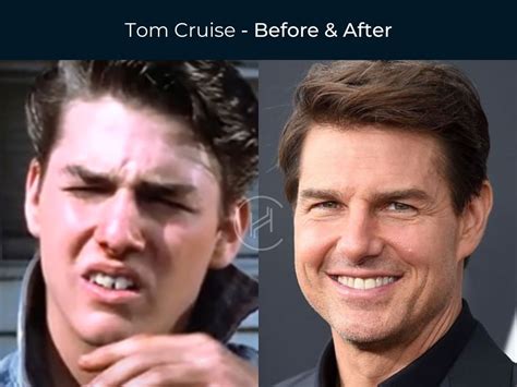 Tom Cruise Teeth Before After