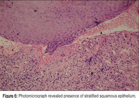 Figure 6 From Oral Mucous Membrane Pemphigoid Two Case Reports With