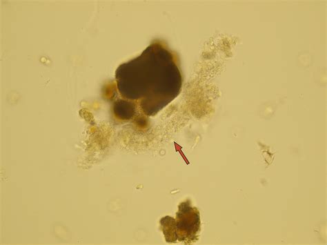 Casts Microscopic Analysis Of Urine Faculty Of Medicine Masaryk