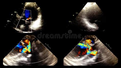 Screen Of Echocardiography Ultrasound Machine Stock Footage Video Of