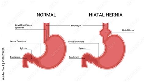 Healthy Stomach And Hiatal Hernia Infographic Stock Vektorgrafik
