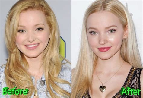 Dove Cameron Before And After Cosmetic Surgery Plastic Surgery Botox