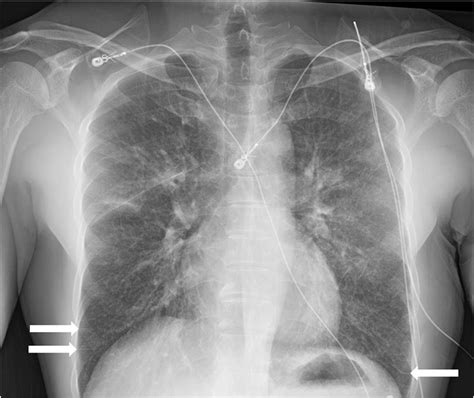 Chest X Ray Showing Interstitial Lung Edema With Kerley B Lines
