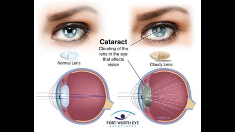 Cataracts Eye Surgery Youtube