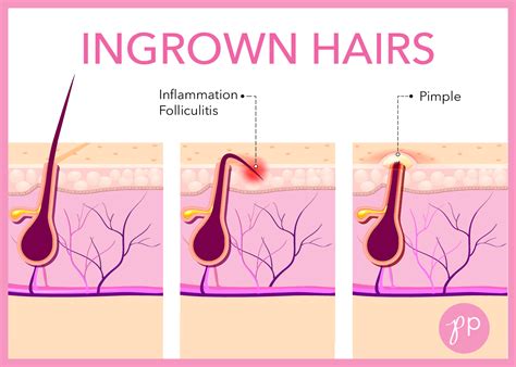 How To Treat Prevent Ingrown Hairs The Pretty Pimple