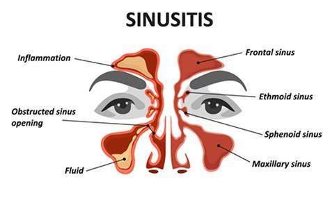 Expert Sinusitis Treatment In Houston Tx Texas Sinus And Snoring