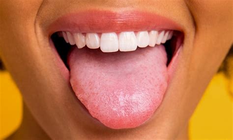 White Spots On Tongue White Spots On Tongue Bumps Patches Painful
