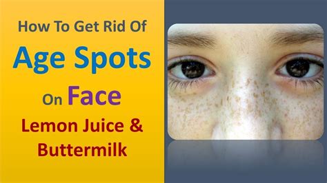 How To Get Rid Of Age Spots On Face Lemon Juice And Buttermilk Youtube