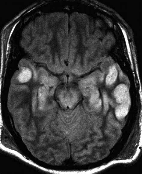 Toxic And Acquired Metabolic Encephalopathies Mri Appearance Ajr