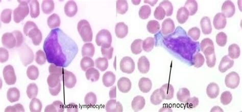 Monocyte And Reactive Lymphocyte Medical Laboratory Hematology