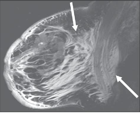 Figure 2—67 From Mri Features Of Inflammatory Breast Cancer Semantic