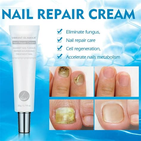 Nail Fungus Treatment Onychomycosis Removal Toenail Repair Cream